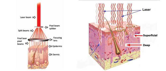 1550nm Diode Laser Principle