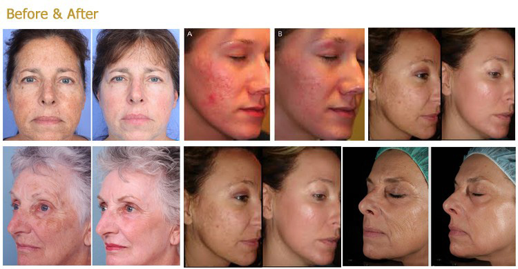 1550nm diode laser treatment before and after