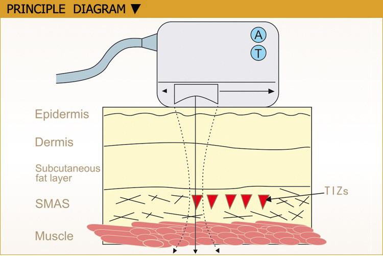 Hifu Beauty Machine Principle Diagram