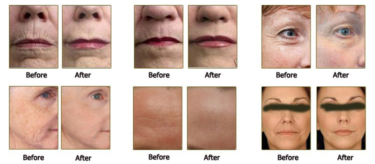 Hifu Beauty Machine Treatment Before and After