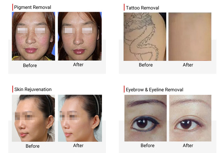 before & after of yag laser machine