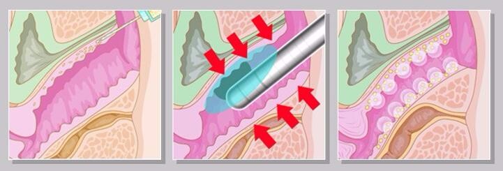 Hifu Vaginal Tightening Machine Principle