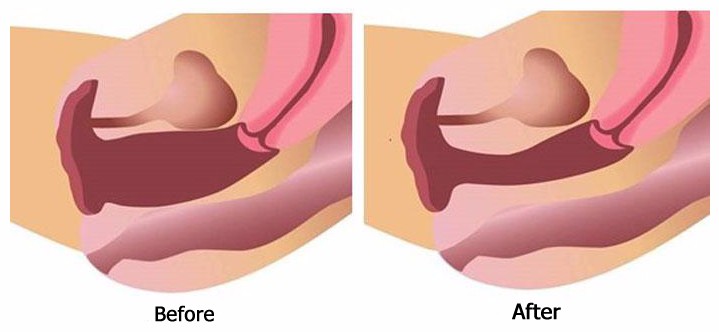 Hifu Vaginal Tightening Treatment Before and After