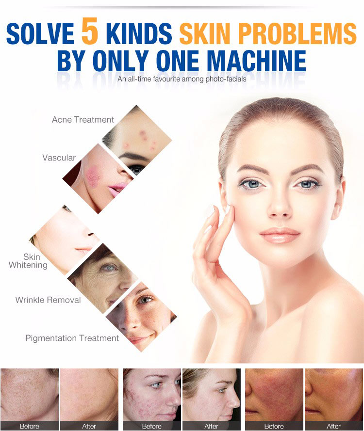 shr ipl treatment machine