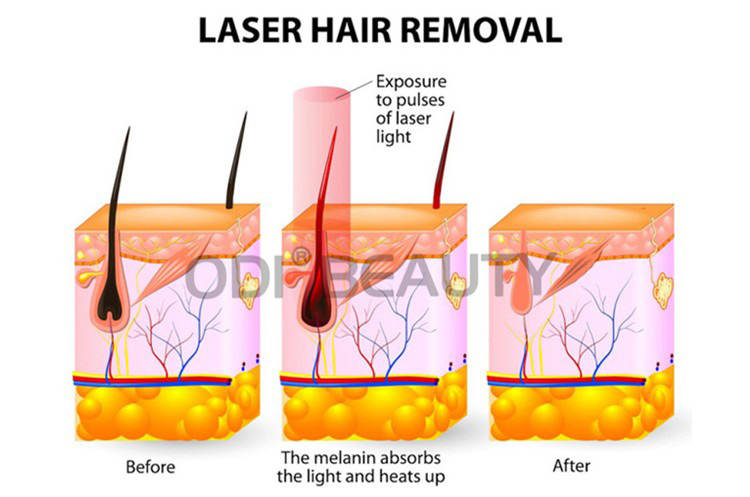 Working Principle of 808nm diode laser hair removal