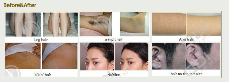 808 Diode Laser Hair Removal Treatment Before and After