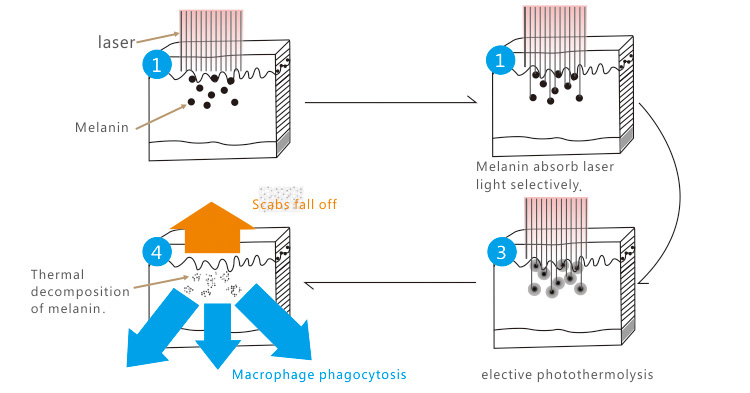 working principle of Q Switched Laser