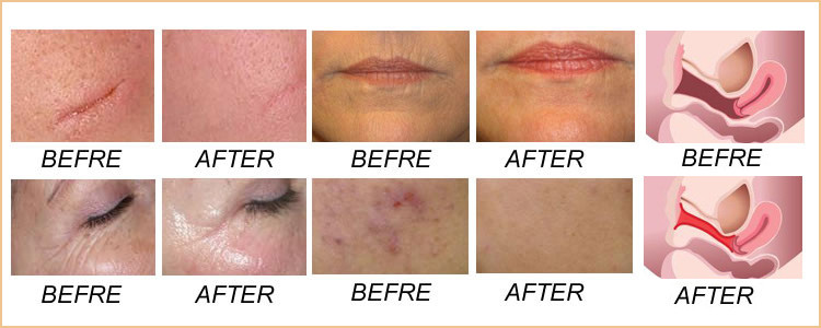 Fractional CO2 Laser Treatment Before and After