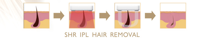 SHR IPL Hair Removal Principle