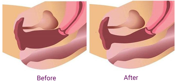 rf vaginal tightening device rf vaginal tightening device