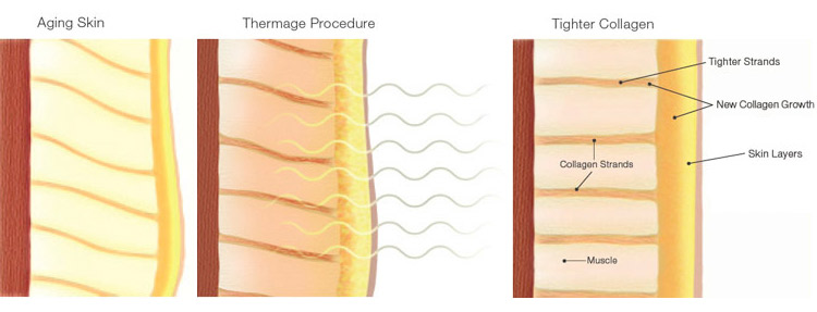 skin tightening rf thermage