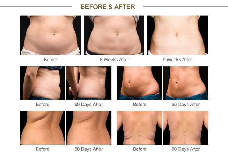 velashape slimming