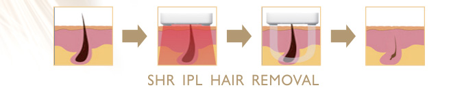 SHR IPL Hair Removal Principle SHR IPL Hair Removal Principle