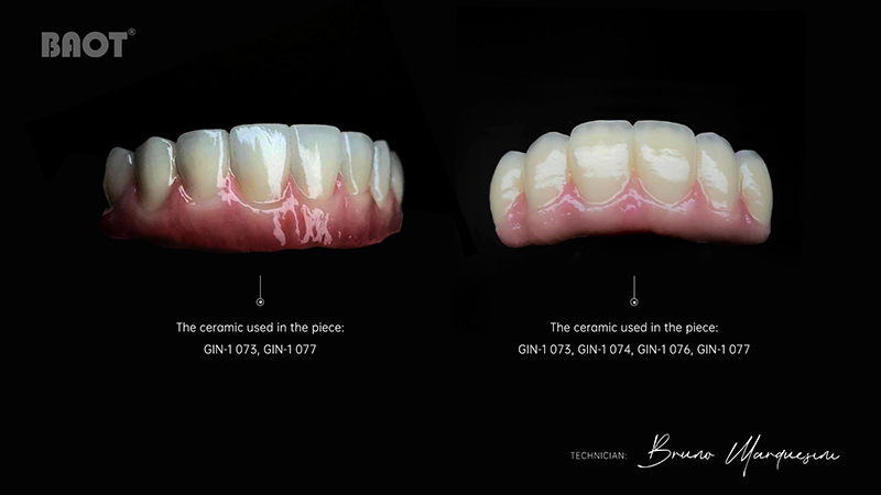 dental porcelain material use for gingiva margin dental porcelain material use for gingiva margin
