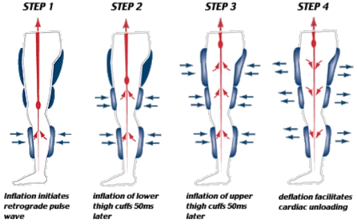 EECP procedure EECP procedure